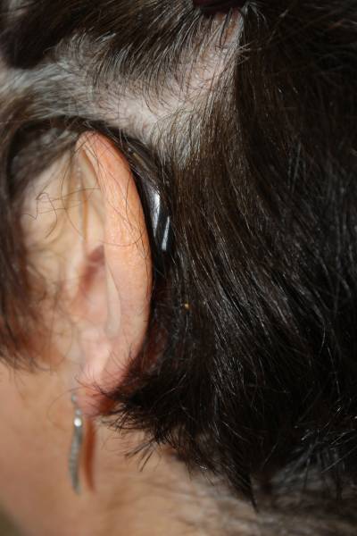 Appareil auditif porté par une patiente