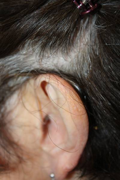 Patiente portant un appareil auditif rechargeable