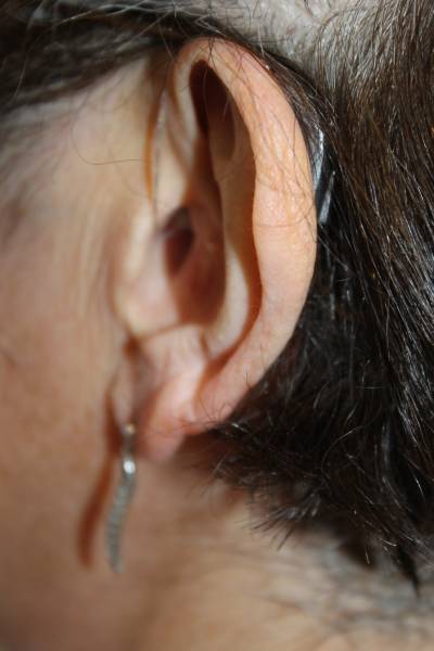 Patiente portant un appareil auditif de type CROS
